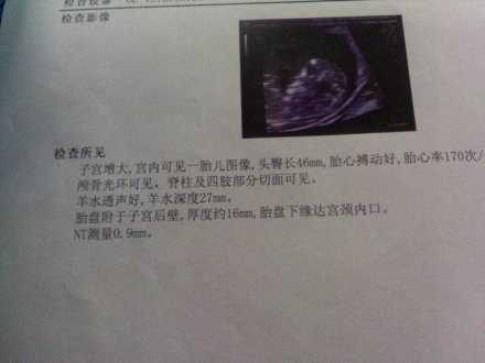 怀孕12周，nt值3mm正常吗？
