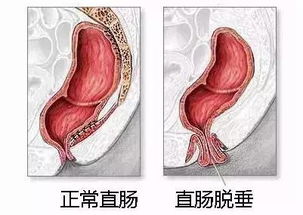 肛肠脱垂有哪些表现啊？？？？？