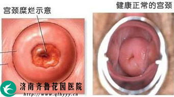 取消宫颈糜烂一说