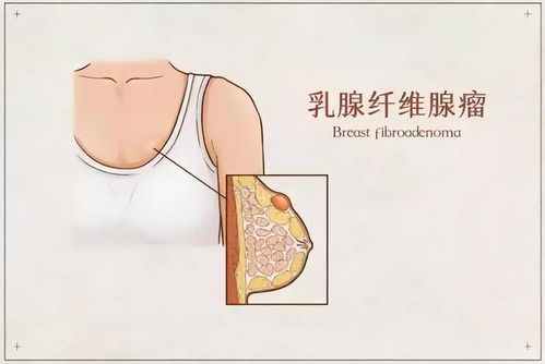 检查乳腺囊肿什么时间最好