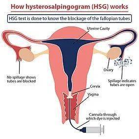 做输卵管检查哪种方法好