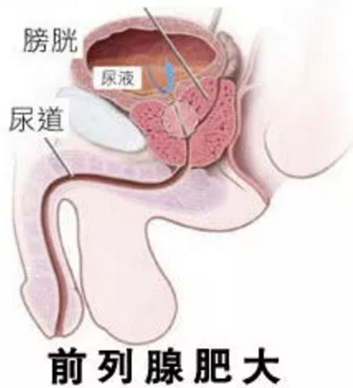 前列腺钙化会影响生孩子吗