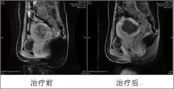 怀孕40多天，B超妊娠囊16*10mm 卵黄囊有，原始心管搏动 无，胚芽 无。