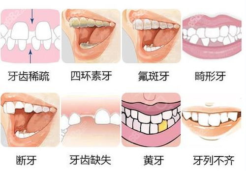 假牙的种类及价格