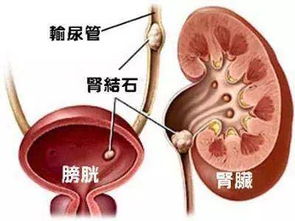 得了结石的孕妇可否继续补钙呢