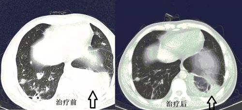 什么是肺炎克雷伯菌？