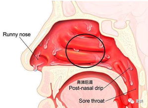 鼻炎 鼻涕倒流