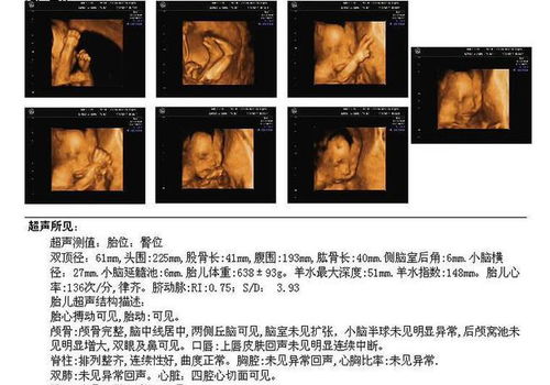 四维彩超排畸检查哪些