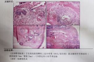 tct和hpv检查都是阳性,就是宫颈癌吗