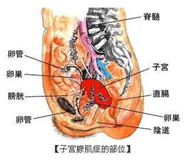 怀孕巧克力囊肿会消失吗