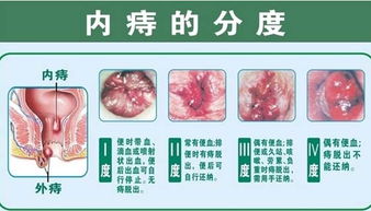 内痔疮该如何治疗