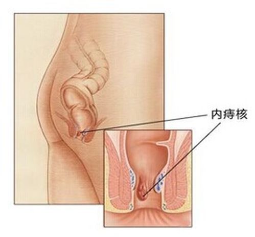 内痔疮该如何治疗