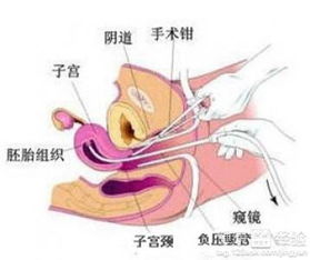 怀孕四个半月能做引产手术么 都应该注意什么啊