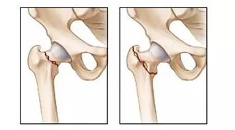 更换股骨头和正常人一样吗
