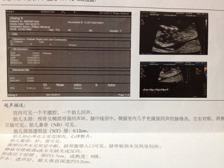 我怀孕13周零3天 想知道男孩还是女孩 这是NT值超声检查