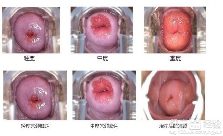 慢性宫颈炎可以吃妇科千金片吗?