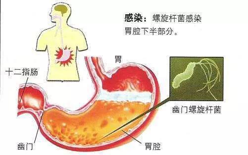 胃炎幽门螺旋杆菌能吃山楂吗