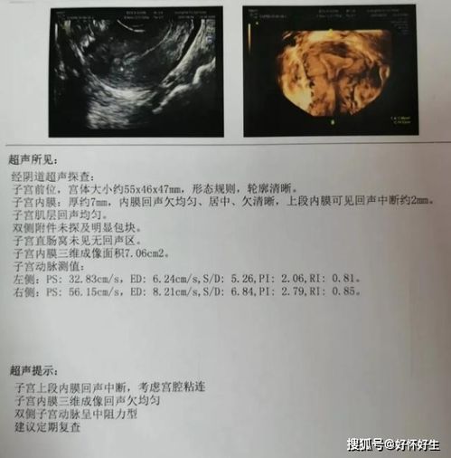 腺肌症要做宫腔镜病理检查吗