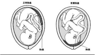 胎盘没有完全取出来的危害有哪些呢