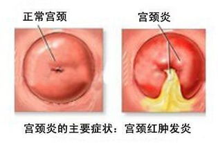 宫颈炎需要做哪些检查能查出来