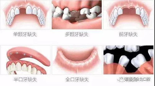 各位知道武汉种植牙怎么样，好吗？