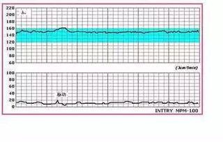 胎心监护仪如何看宫缩图片