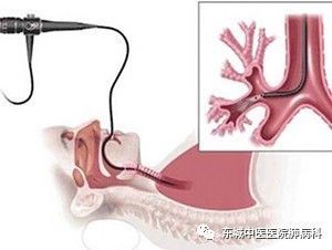 怎么治疗小儿支气管哮喘