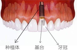 做种植牙会疼吗？