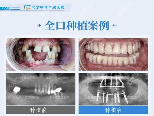 想知道在广东省口腔医院种两颗烤瓷牙需要多少钱？