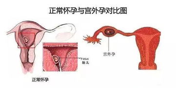 宫外孕腹痛是哪种痛法