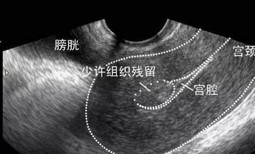 刮宫后流血怎么办呢