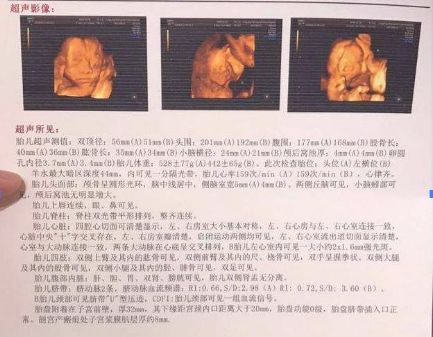 孕24周四维彩超上双肾未见分离是什么意思