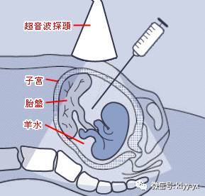 无创和羊水穿刺必须要做吗