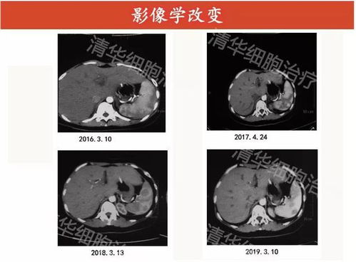 囊29 18mm，可见卵黄囊和胚芽，未见明显血管搏动是什么原因